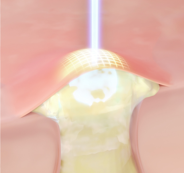 땡큐피부과 애플레이저