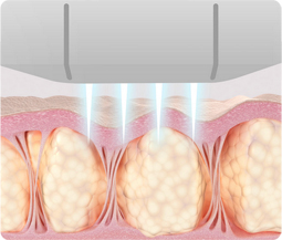 땡큐피부과 울쎄라프라임