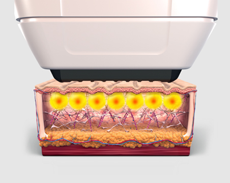 땡큐피부과 소프웨이브 POINT