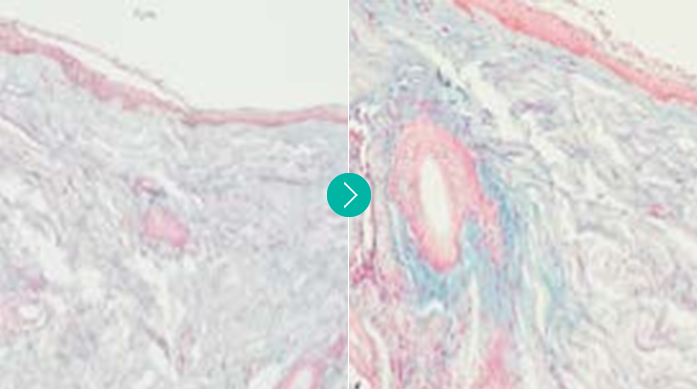 땡큐피부과 소프웨이브 POINT