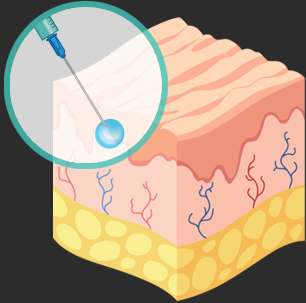 땡큐피부과 스컬트라 콜라겐 생성원리
