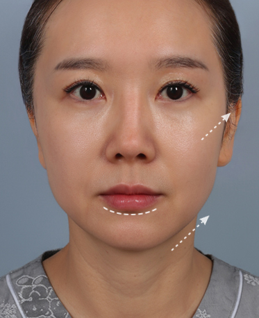 땡큐피부과 전후사진