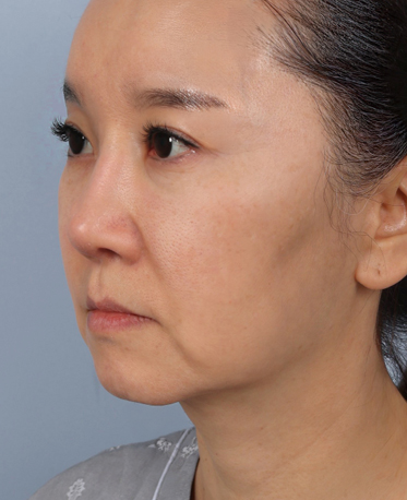 땡큐피부과 전후사진