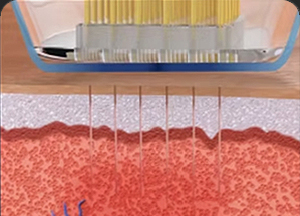 땡큐피부과 버츄RF