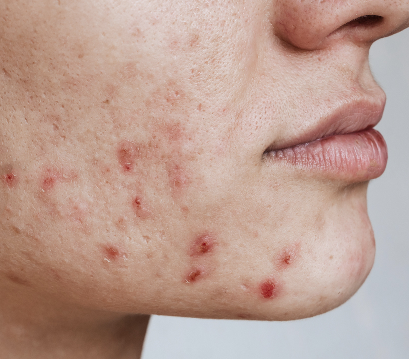 땡큐피부과 여드름 케어