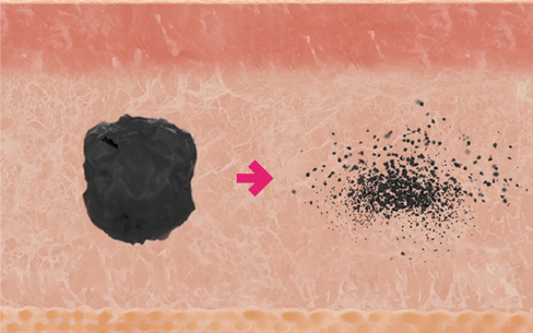 땡큐피부과 문신제거