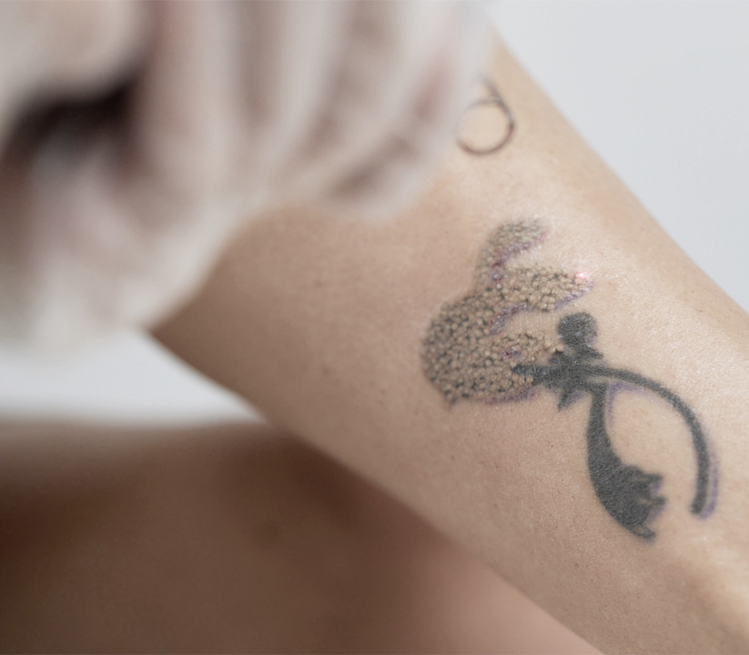 땡큐피부과 문신제거