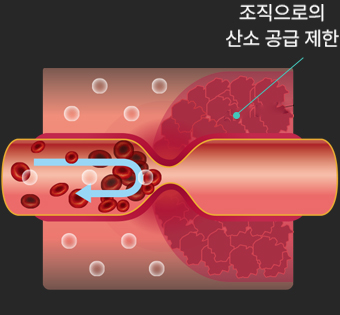아이벡스 고압산소