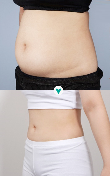 디에이징클리닉 전후사진