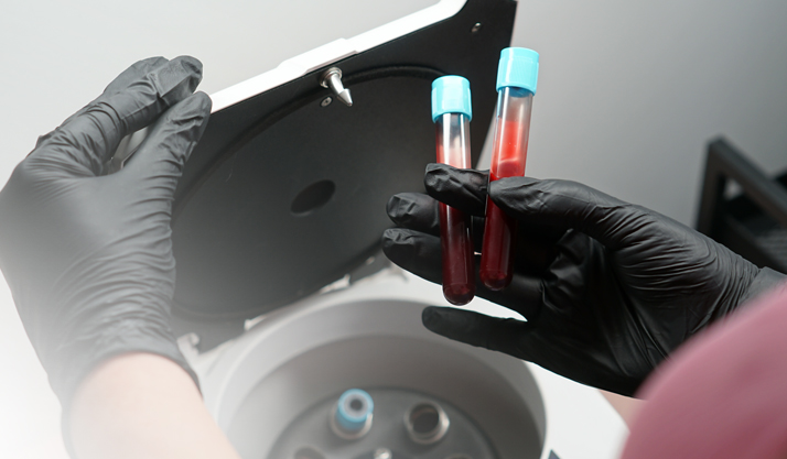 PRP 자가혈 치료