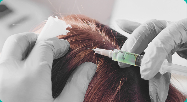 비수술 탈모주사 치료