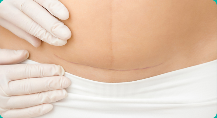 수술 후 흉터치료